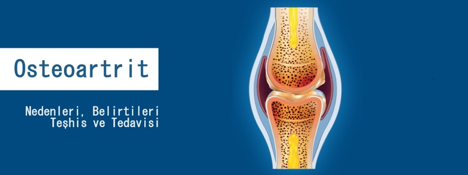 Osteoartrit (Kireçlenme) Nedir